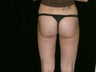 Liposuction