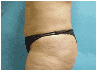 true tumescent lipo