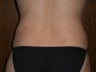 Liposuction
