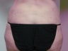 Liposuction
