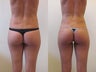 Liposculpture