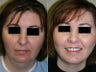 Submental and Neck Liposculpture