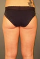 Tumescent Liposuction Under Local Anesthesia.