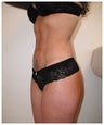 Liposulpture of abdomen, waist, flanks and inner thighs.