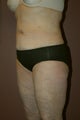 Liposuction