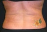 Lipo for back
