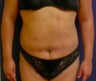 Liposculpture for stomach