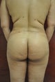 Liposuction of the hips
