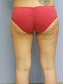Laser Lipo on Outer Thighs