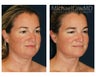 Chin Liposuction