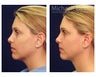 Chin Liposuction