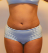 Liposuction