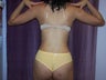 Liposuction
