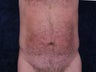 Liposuction to the waist and hips.