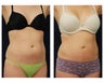 Liposuction