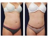 Liposuction