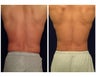 Liposuction