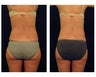 Liposuction