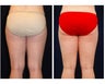 Liposuction
