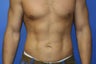 High-Definition Liposuction