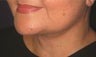 Liposculpting of neck, neck lift and facelift