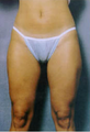 Suction Lipectormy of Inner and Outer thighs