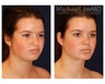 Chin Liposuction
