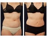 Liposuction