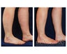 Liposuction