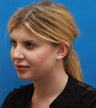 Neck Lipocontouring