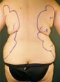 Pure Tumescent Liposuction