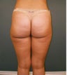 Tumescent Liposuction