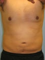 Liposuction Male