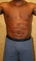 liposuction of abdomen and flanks of man from Los Angeles