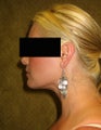 liposuction of neck & jaw line for women