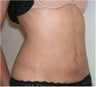 Liposculpturing