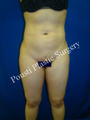 Liposuction