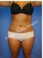 Liposuction