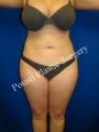 Liposuction