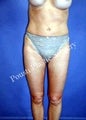 Liposuction
