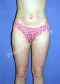 Liposuction