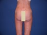 Thigh Liposculpture