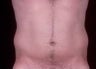 Liposuction