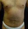Liposculpture, Liposuction for men