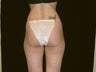 Liposuction