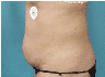 true tumescent lipo