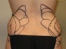 Liposuction