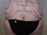 Liposuction