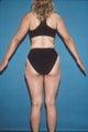 Total Body Liposculpture