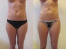 Liposculpture